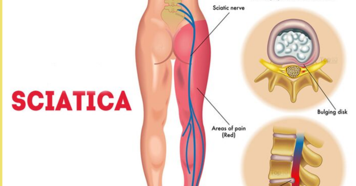 Sciatica Pain Treatment in Mumbai